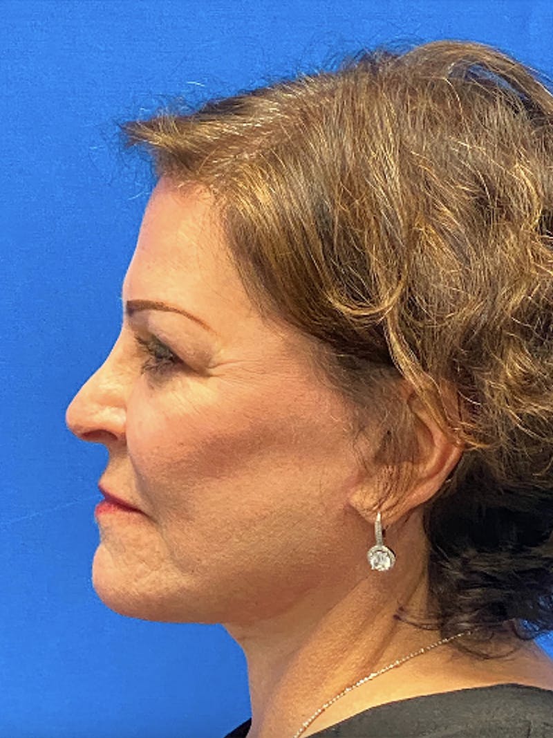 Facelift Before & After Gallery - Patient 181164 - Image 6