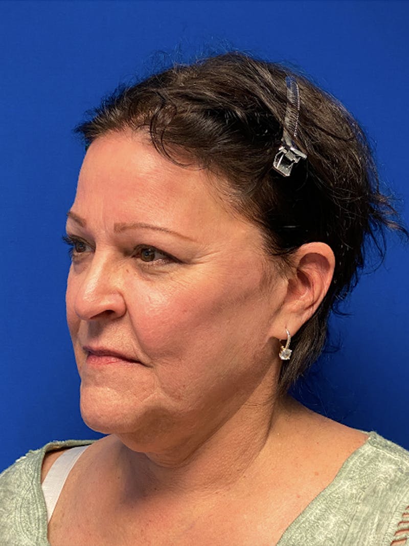Facelift Before & After Gallery - Patient 181164 - Image 3
