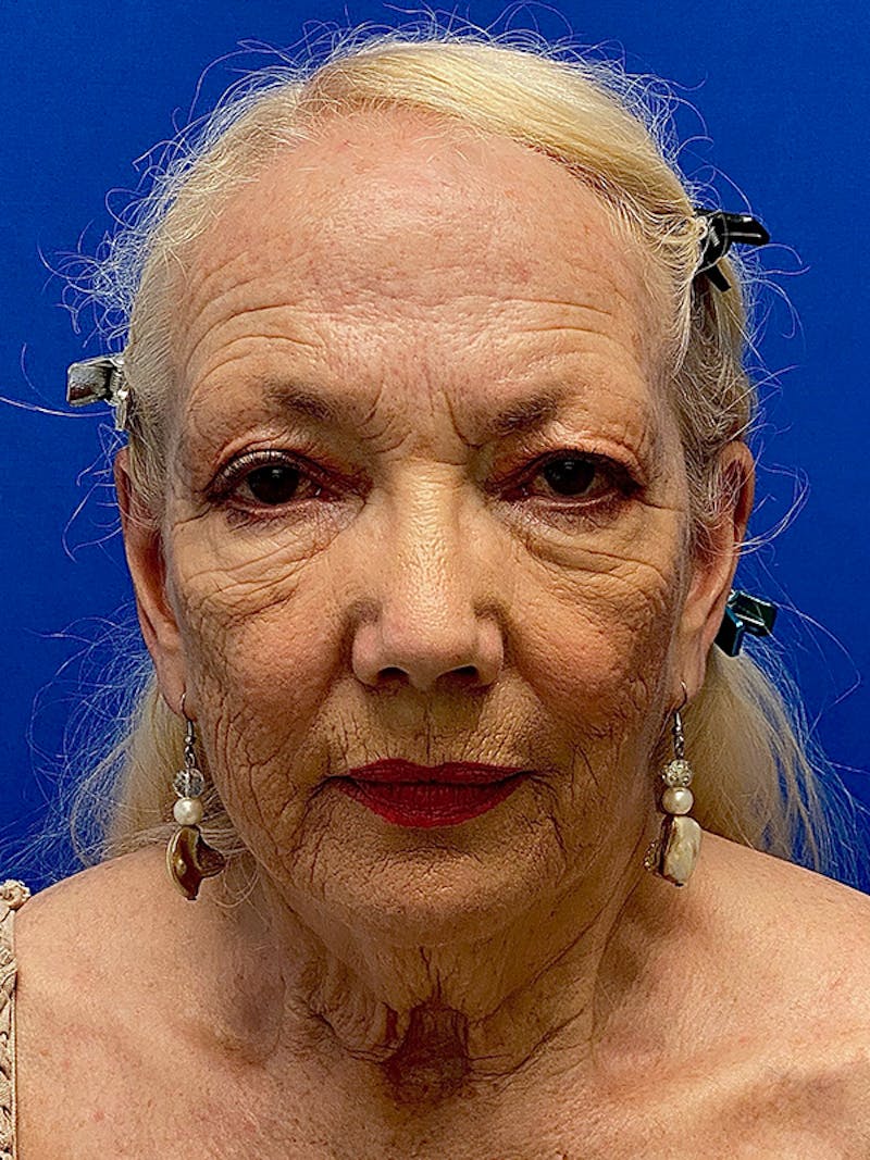Facelift Before & After Gallery - Patient 326906 - Image 1