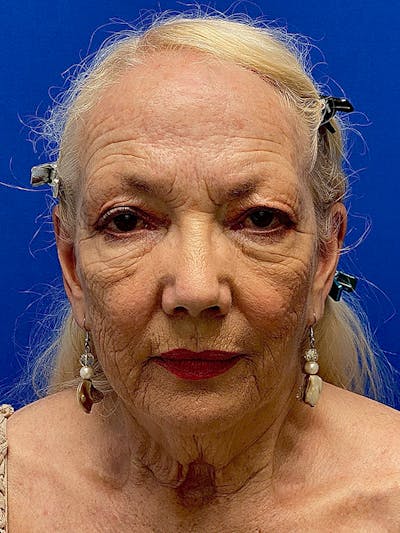 Facelift Before & After Gallery - Patient 326906 - Image 1