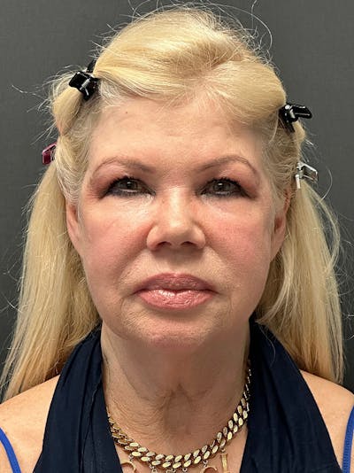 Facelift Before & After Gallery - Patient 112257 - Image 1