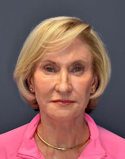 Facelift Before & After Gallery - Patient 336873 - Image 2