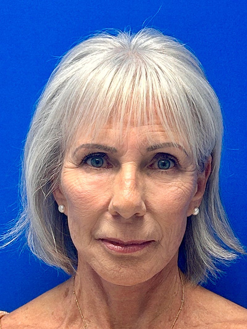 Facelift Before & After Gallery - Patient 349518 - Image 2