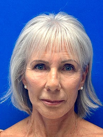 Facelift Before & After Gallery - Patient 349518 - Image 2