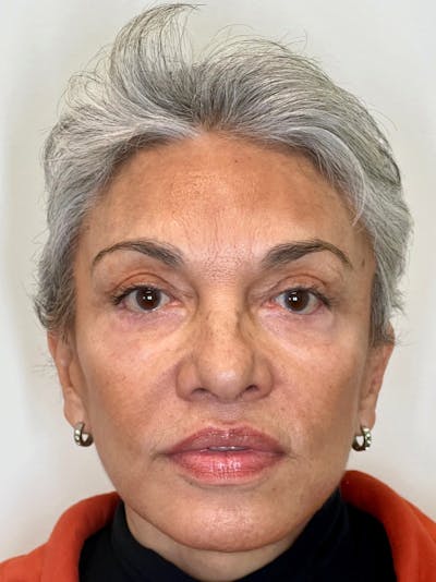 Facelift Before & After Gallery - Patient 748687 - Image 2