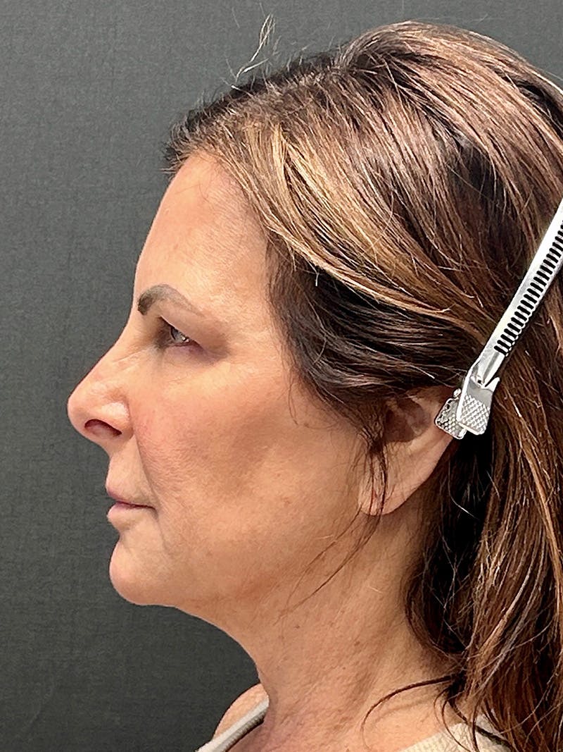 Neck Lift Before & After Gallery - Patient 362491 - Image 5