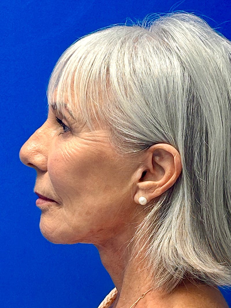Facelift Before & After Gallery - Patient 349518 - Image 6