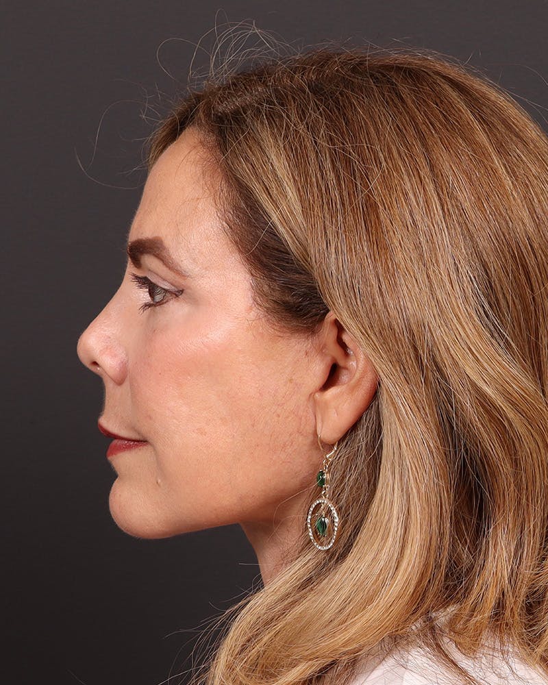 Facelift Before & After Gallery - Patient 161108 - Image 6