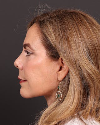 Facelift Before & After Gallery - Patient 161108 - Image 6