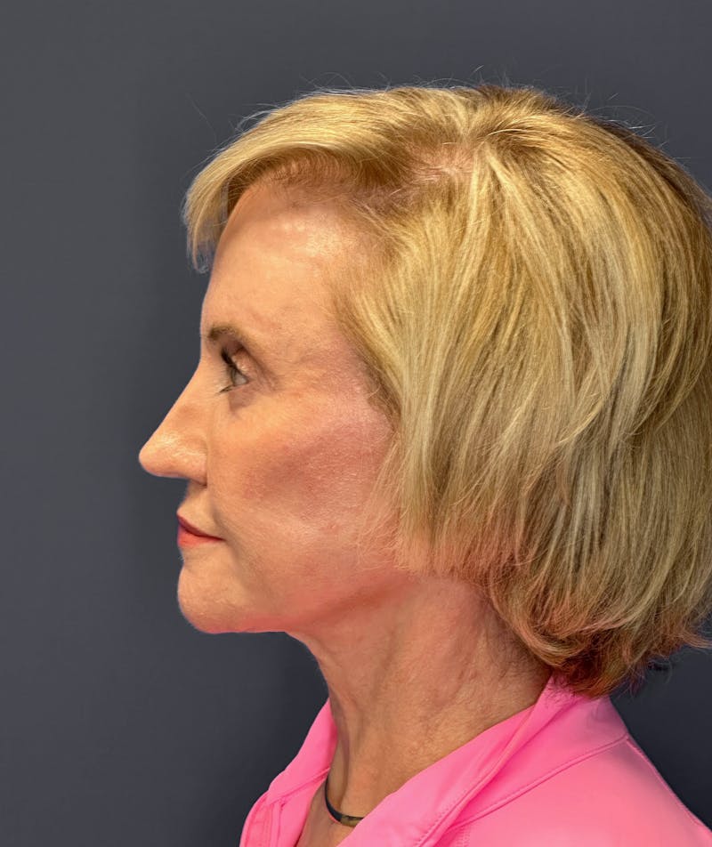 Blepharoplasty Before & After Gallery - Patient 108643 - Image 6