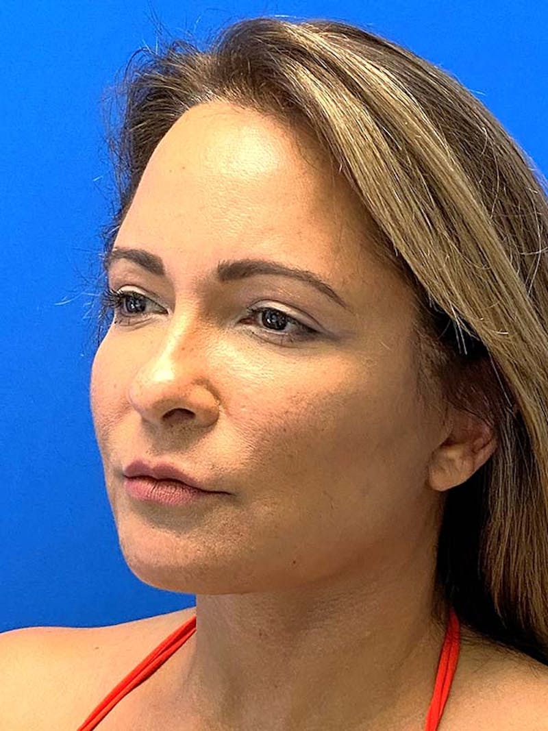 Facelift Before & After Gallery - Patient 181295 - Image 8