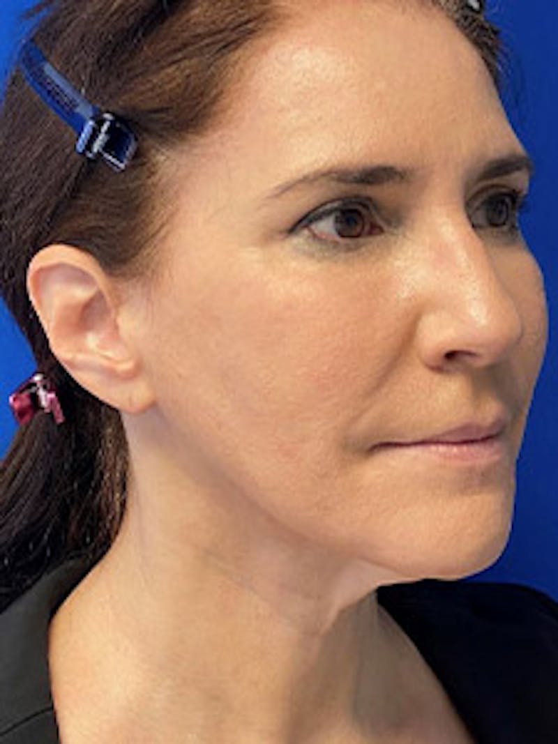 Facelift Before & After Gallery - Patient 327892 - Image 1