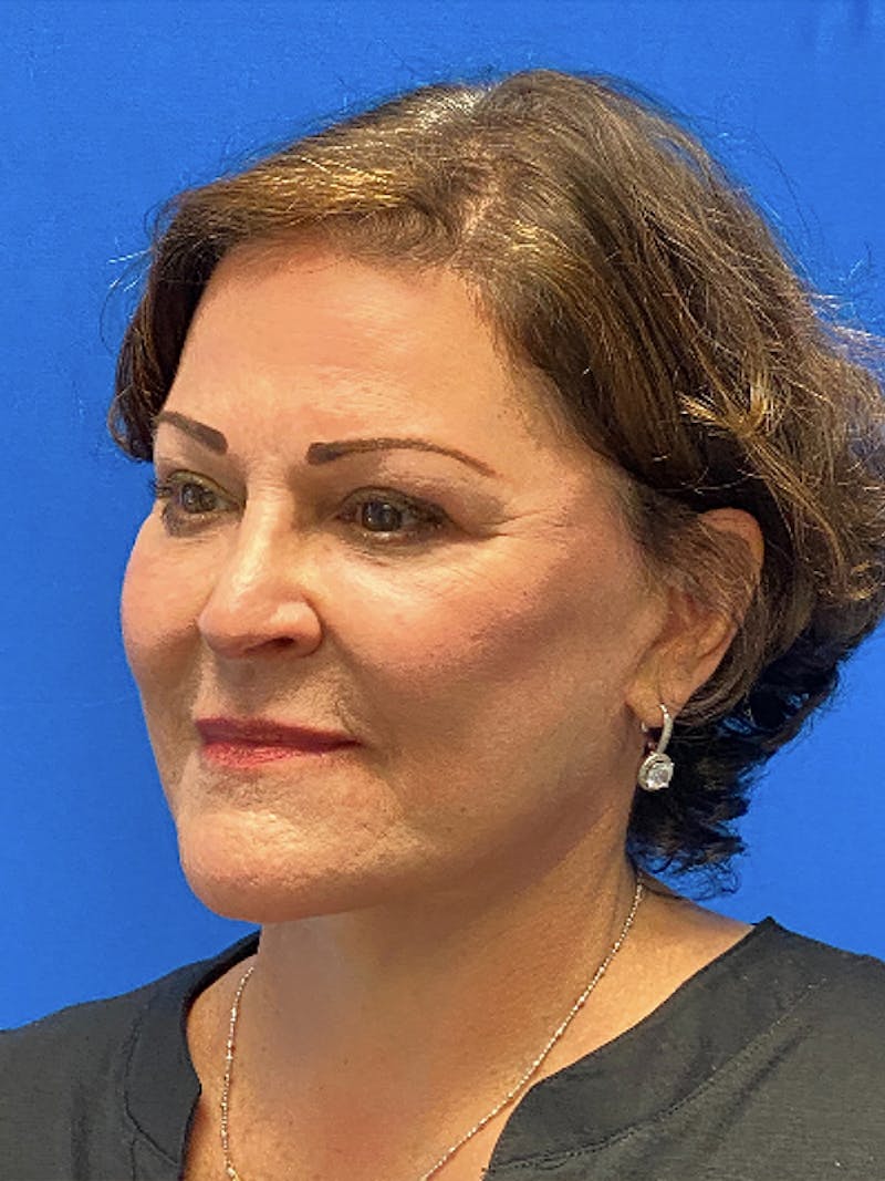 Facelift Before & After Gallery - Patient 181164 - Image 4