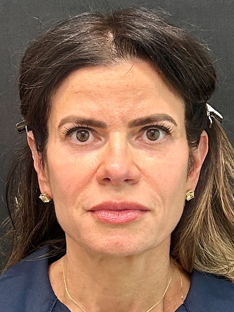 Brow Lift Before & After Gallery - Patient 387096 - Image 1