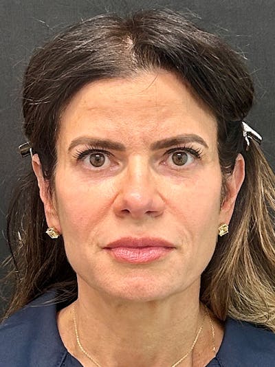 Facelift Before & After Gallery - Patient 179050 - Image 1