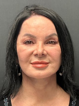 Blepharoplasty Before & After Gallery - Patient 409475 - Image 2