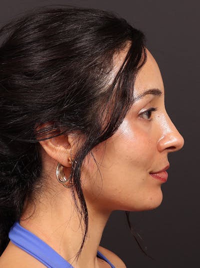 Primary Rhinoplasty Before & After Gallery - Patient 319902 - Image 2