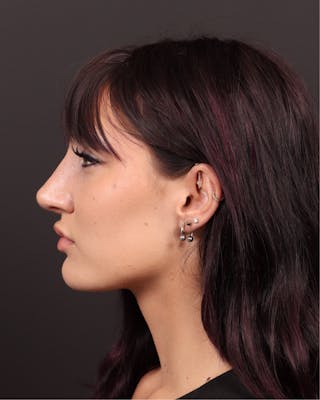 Primary Rhinoplasty Before & After Gallery - Patient 420494 - Image 8