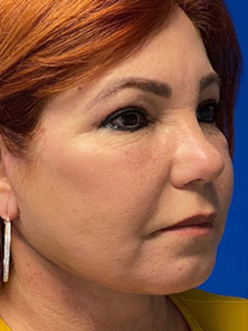 Facelift Before & After Gallery - Patient 287841 - Image 6