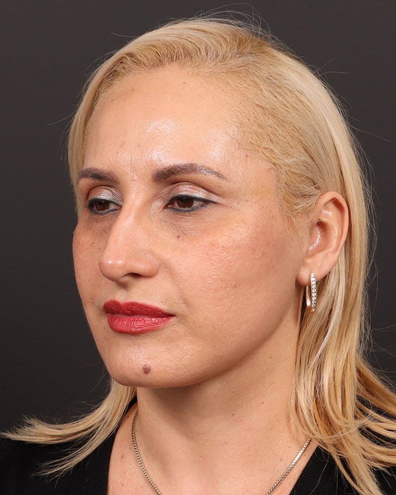Facelift Before & After Gallery - Patient 104845 - Image 2