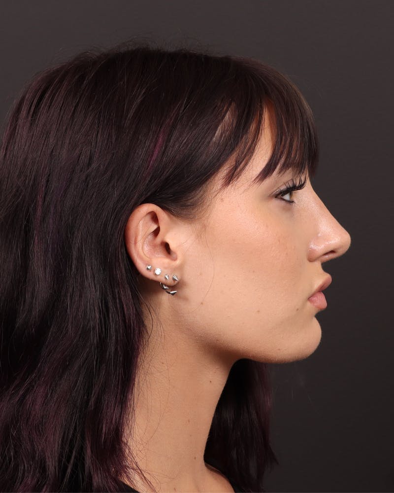 Primary Rhinoplasty Before & After Gallery - Patient 420494 - Image 2