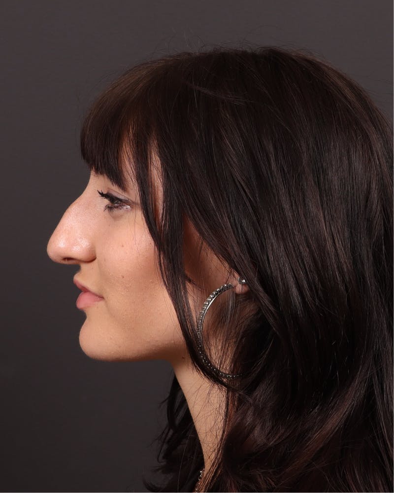 Primary Rhinoplasty Before & After Gallery - Patient 420494 - Image 7