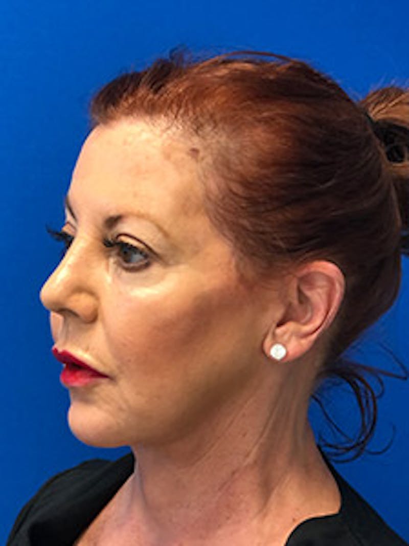 Facelift Before & After Gallery - Patient 344009 - Image 4