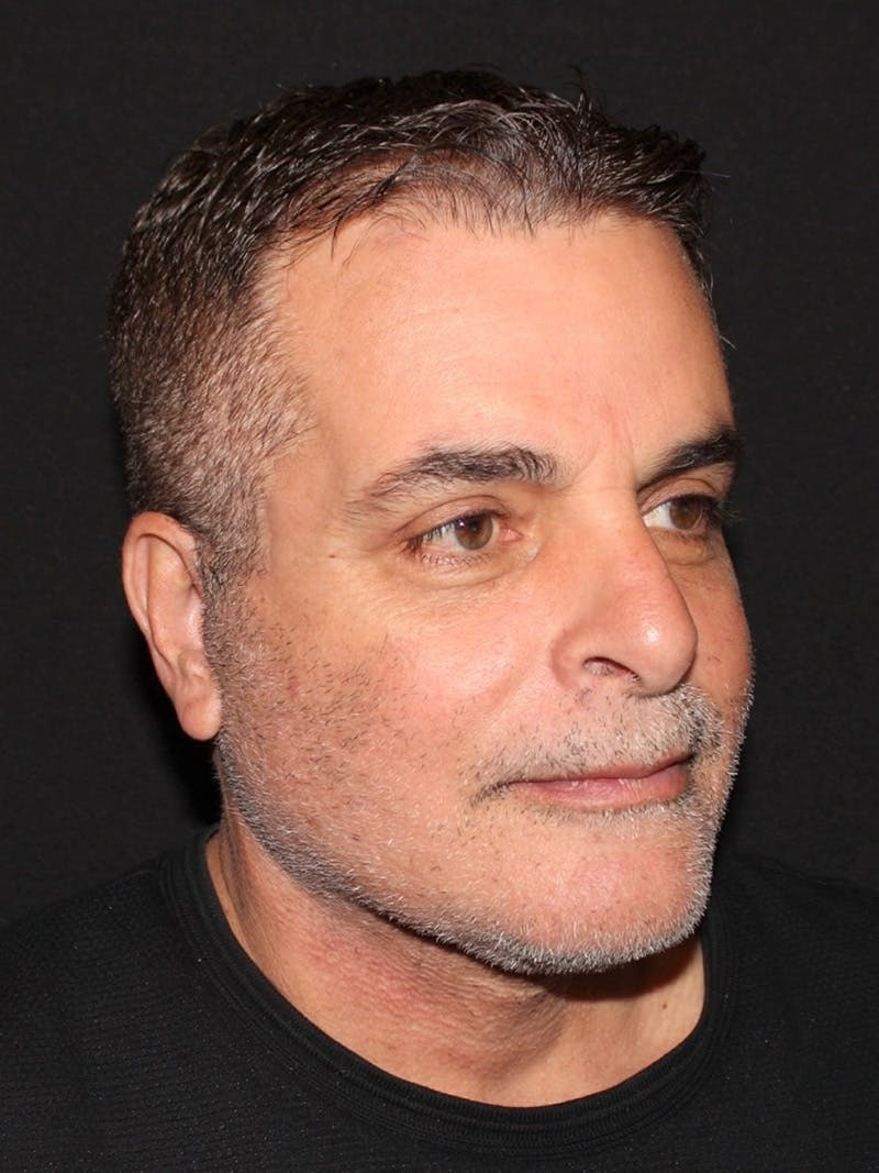 Blepharoplasty Before & After Gallery - Patient 316919 - Image 4