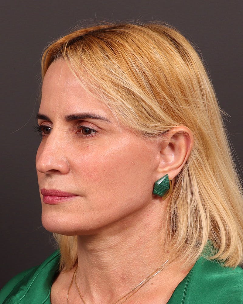 Facelift Before & After Gallery - Patient 965600 - Image 4