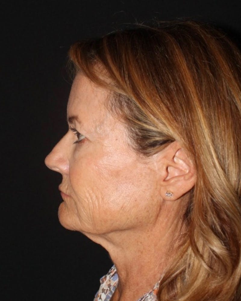 Facelift Before & After Gallery - Patient 287189 - Image 1