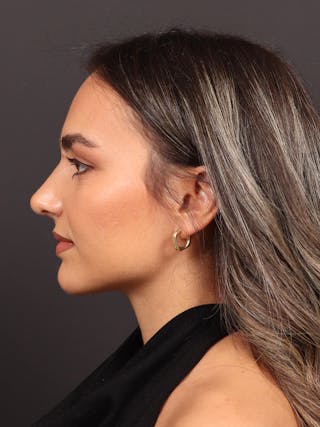 Primary Rhinoplasty Before & After Gallery - Patient 933905 - Image 10
