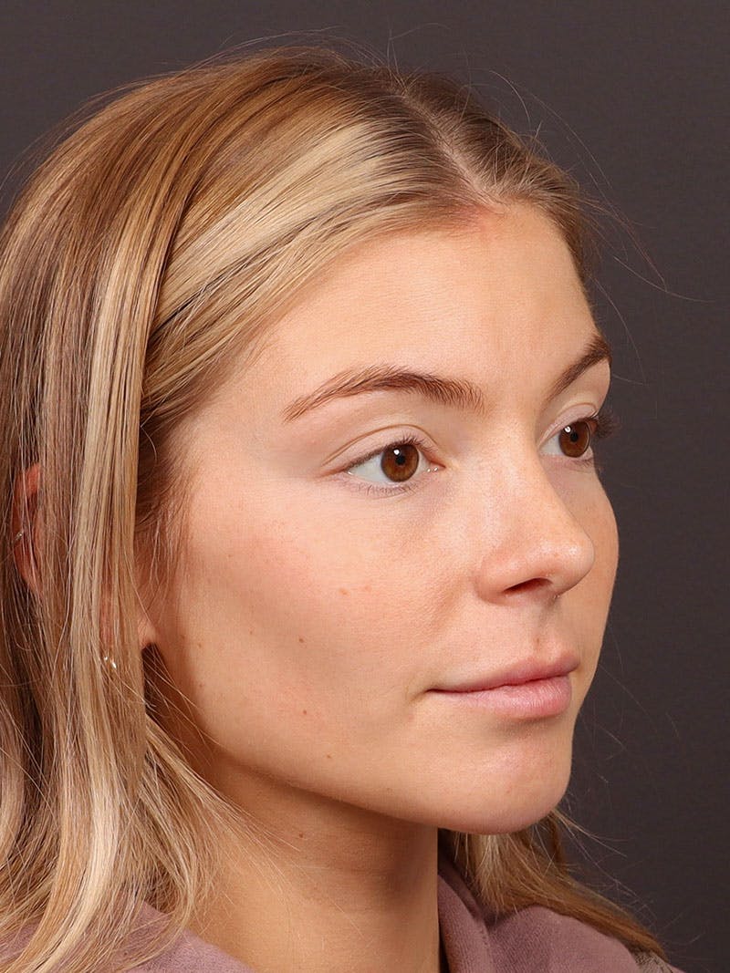 Primary Rhinoplasty Before & After Gallery - Patient 194014 - Image 6
