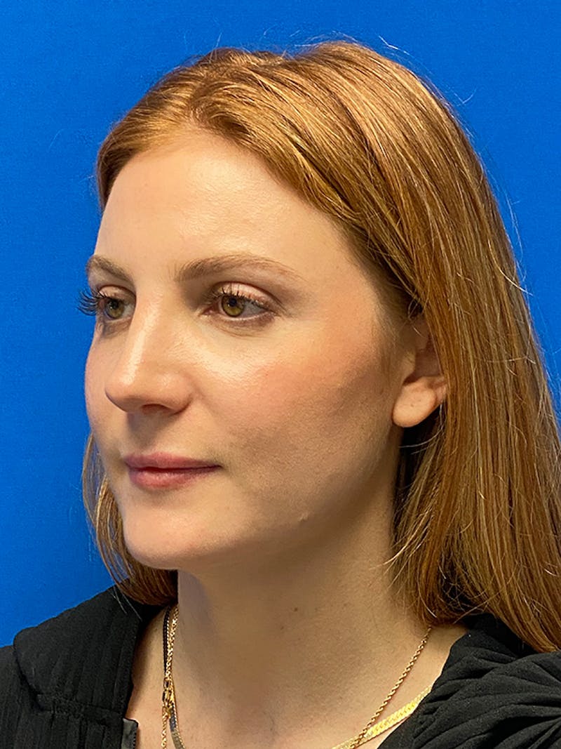 Primary Rhinoplasty Before & After Gallery - Patient 202446 - Image 8