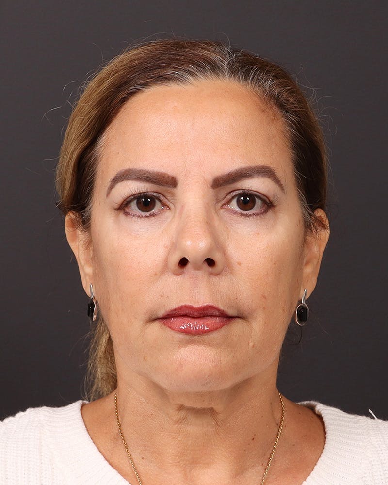 Facelift Before & After Gallery - Patient 161108 - Image 1