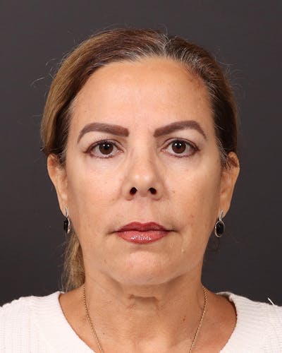 Facelift Before & After Gallery - Patient 161108 - Image 1
