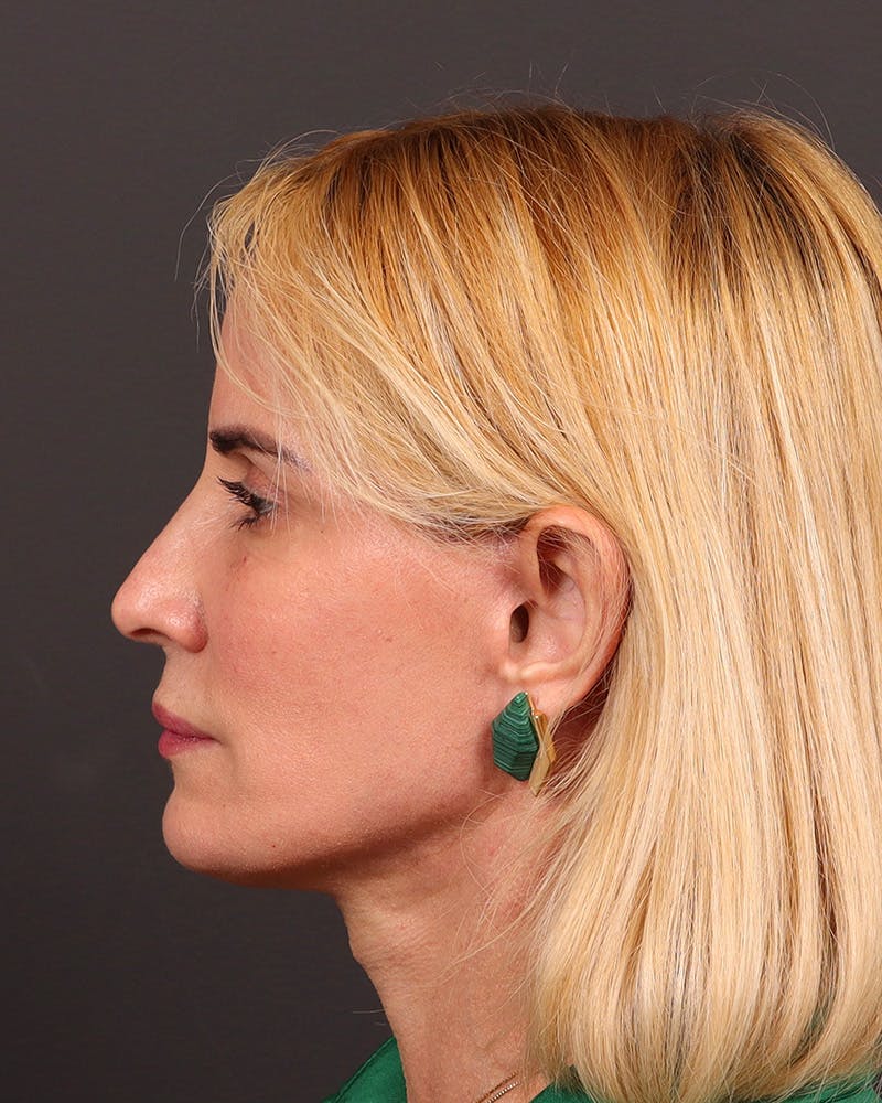 Facelift Before & After Gallery - Patient 965600 - Image 6