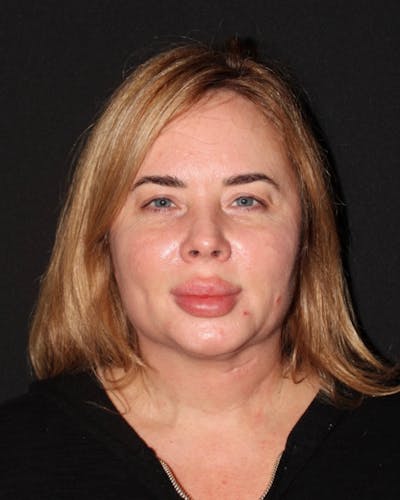 Facelift Before & After Gallery - Patient 302291 - Image 1