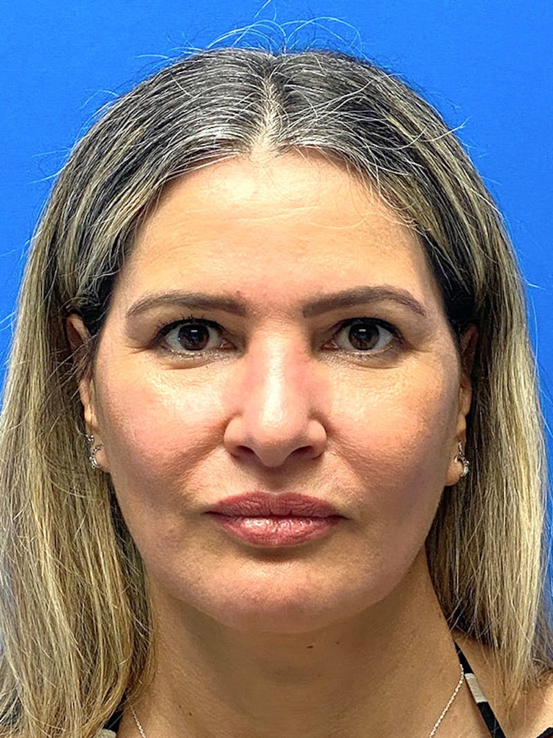 Revision Rhinoplasty Before & After Gallery - Patient 283261 - Image 3