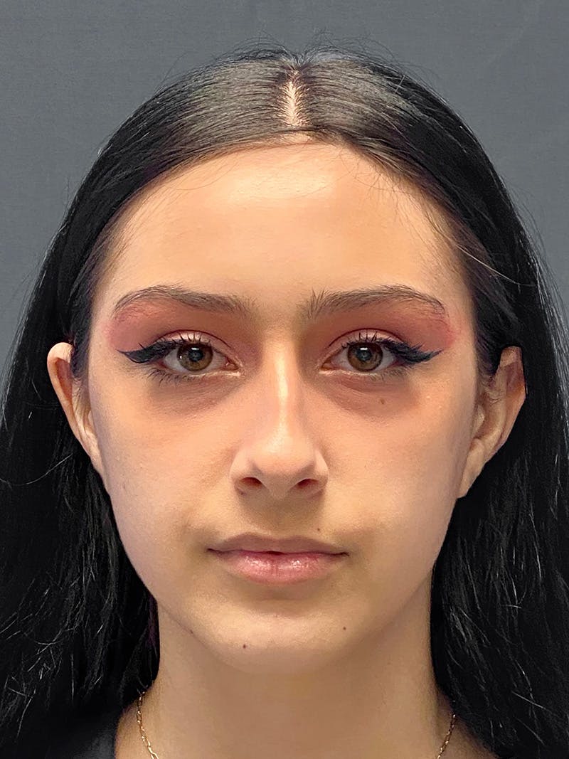 Primary Rhinoplasty Before & After Gallery - Patient 330004 - Image 3
