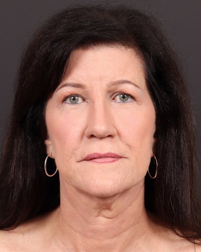Facelift Before & After Gallery - Patient 116970 - Image 1