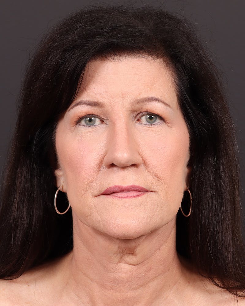 Facelift Before & After Gallery - Patient 116970 - Image 1