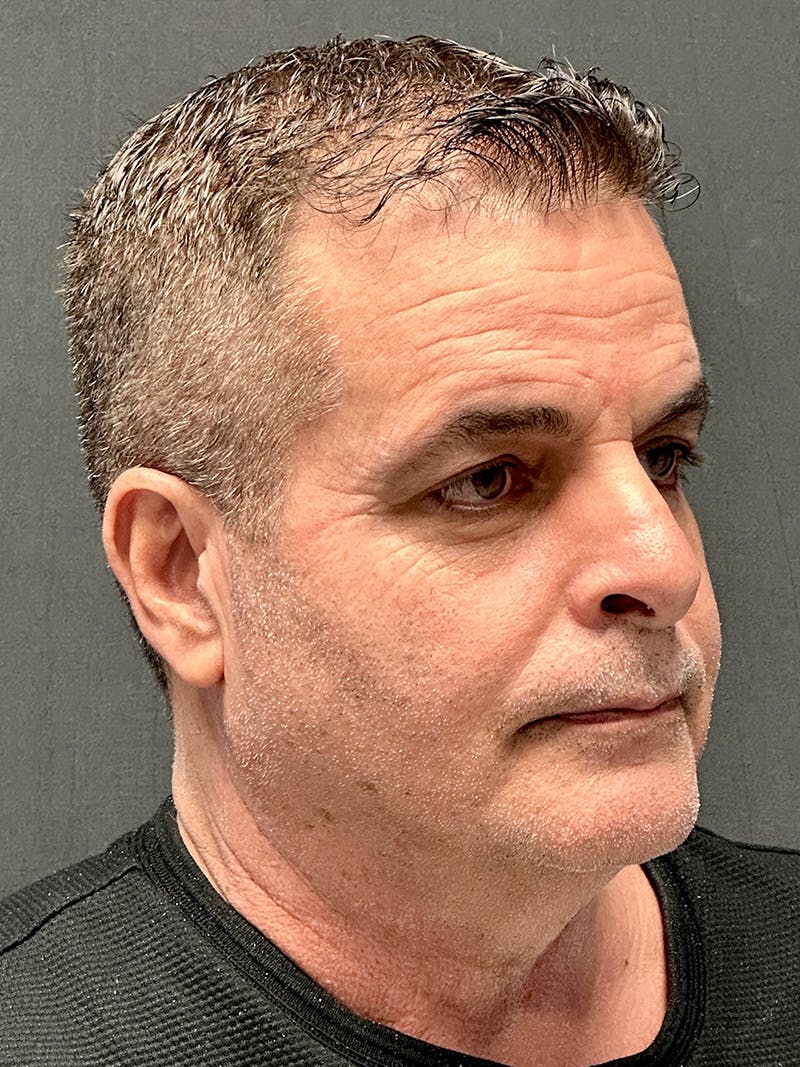 Blepharoplasty Before & After Gallery - Patient 316919 - Image 3
