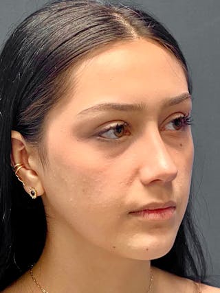 Primary Rhinoplasty Before & After Gallery - Patient 330004 - Image 6