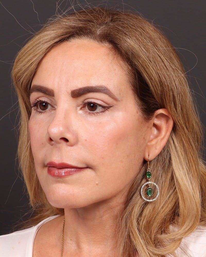 Facelift Before & After Gallery - Patient 161108 - Image 4
