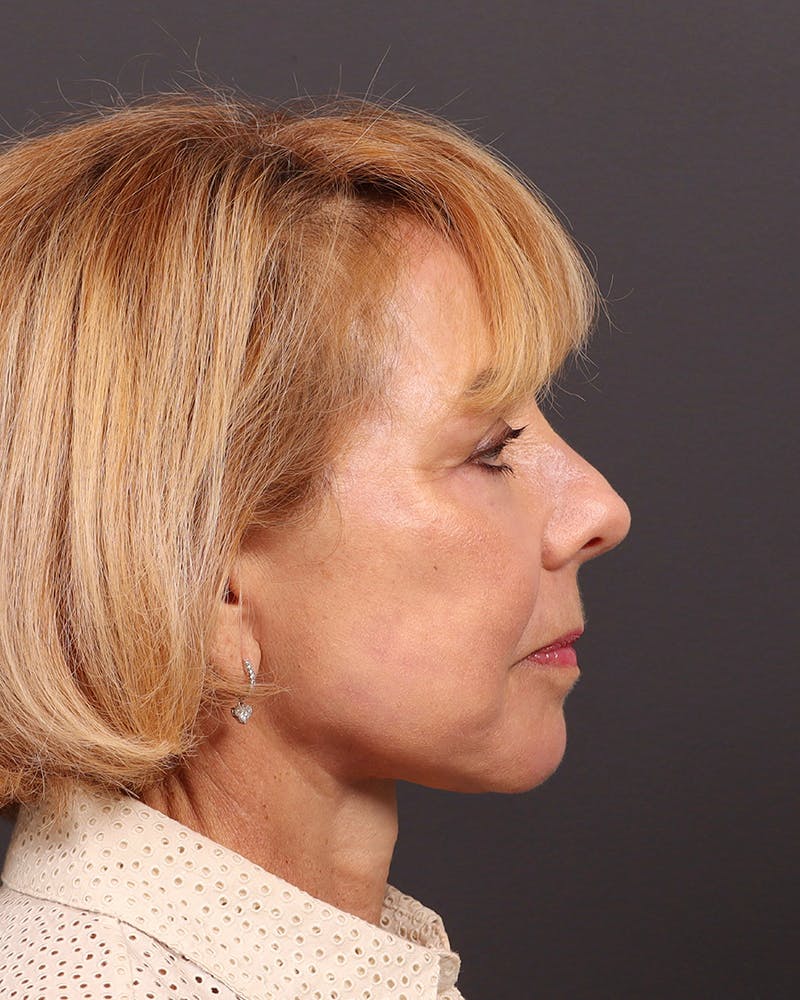 Facelift Before & After Gallery - Patient 304571 - Image 6
