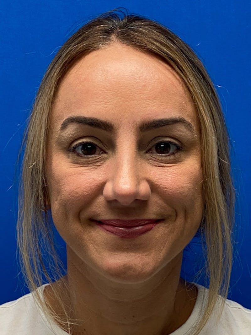 Primary Rhinoplasty Before & After Gallery - Patient 784658 - Image 4