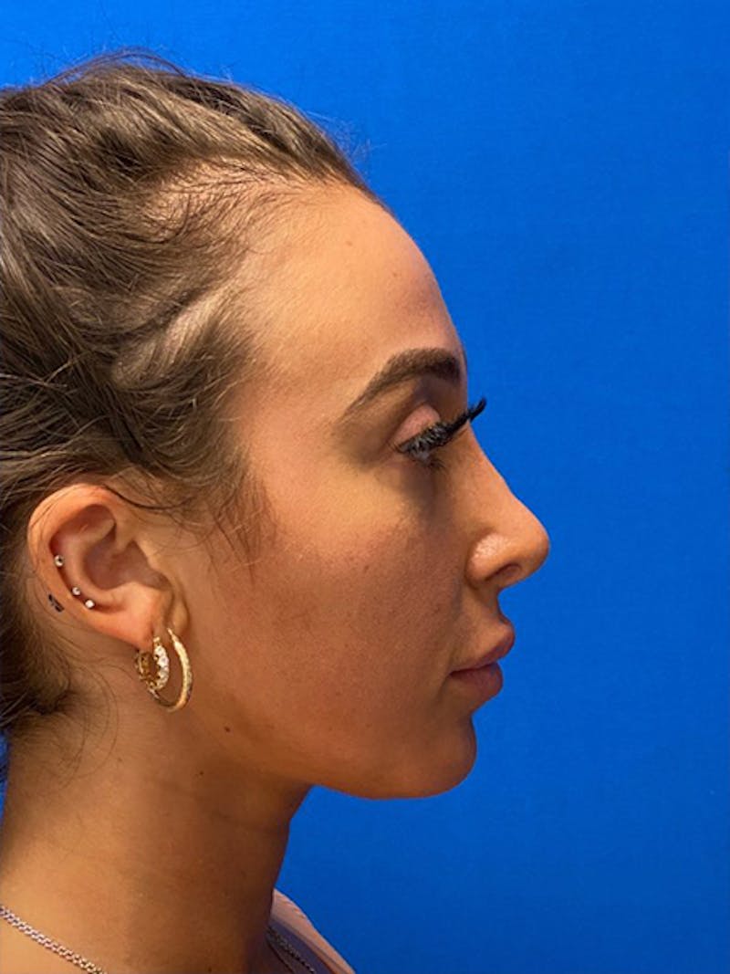 Primary Rhinoplasty Before & After Gallery - Patient 334537 - Image 1