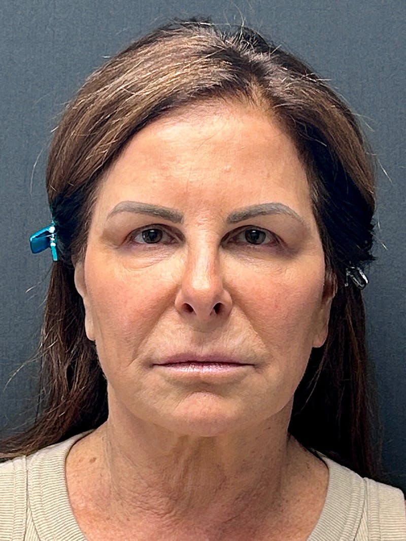 Neck Lift Before & After Gallery - Patient 362491 - Image 1
