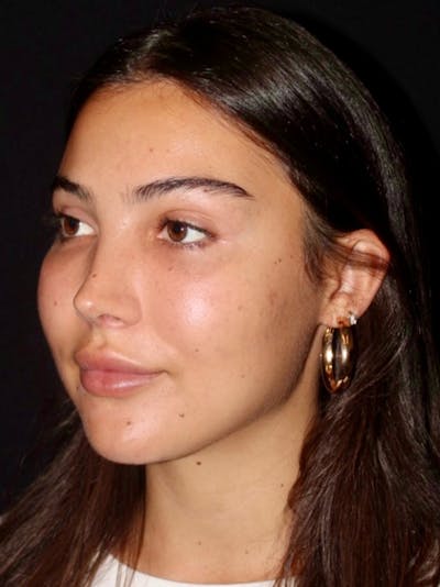 Primary Rhinoplasty Before & After Gallery - Patient 292088 - Image 2