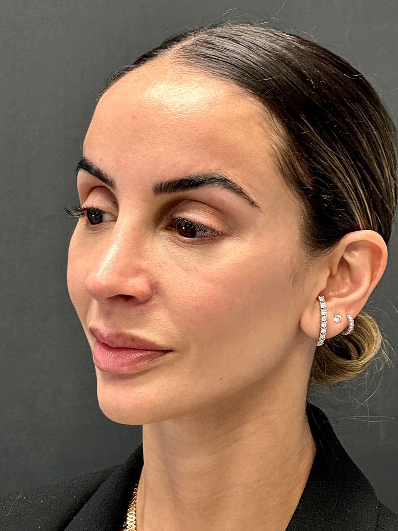 Brow Lift Before & After Gallery - Patient 183593 - Image 4